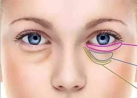 深圳丝足坊教你利用生活小妙招去除眼袋